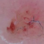 Morgellons