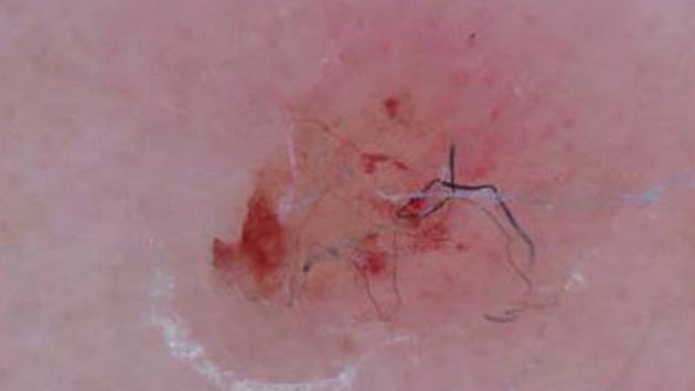 La misteriosa enfermedad de Morgellons